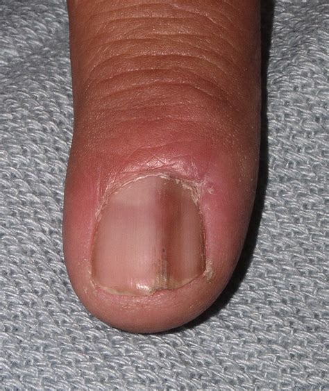 Nail matrix biopsy of longitudinal melanonychia: Diagnostic algorithm including the matrix shave ...