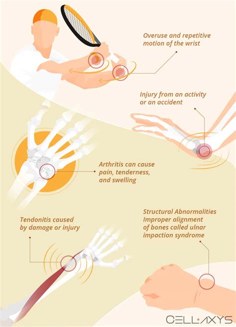 How To Manage Ulnar-Sided Wrist Pain With A Brace? - Cellaxys