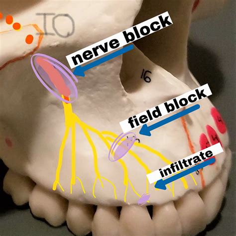 INFILTRATION -vs- NERVE BLOCK