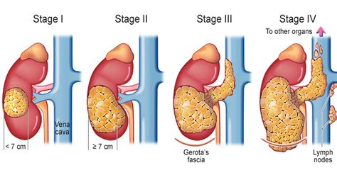 Kidney Cancer TreatmentDr. Shailendra Goel