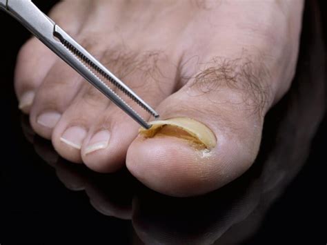 Toenail Fungus Relief in Los Angeles - Toenail fungus Treatment Center