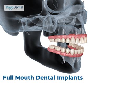 Understand the Benefits and Risks of Full Mouth Dental Implants