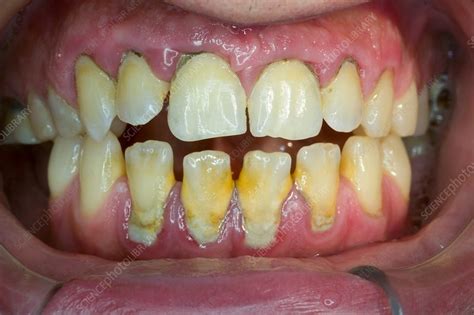 Dental tartar before cleaning - Stock Image - C037/3011 - Science Photo ...