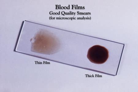 Malaria Parasite Smear