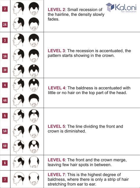 What level are you at on THE NORWOOD SCALE? What is The Norwood Scale ...