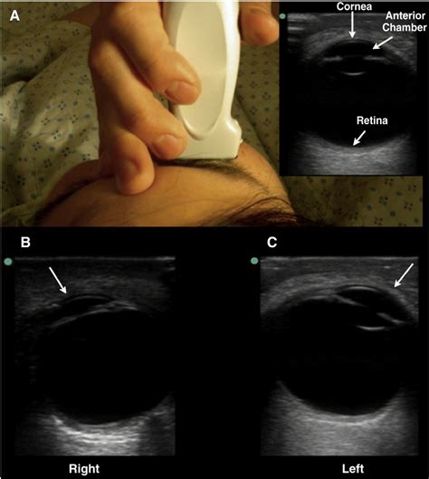 Ultrasound assessment of extraocular movements and pupillary light ...