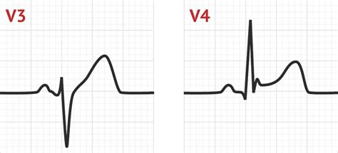 The ST Segment | ECG Basics - MedSchool