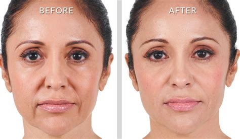 Non-Surgical Treatment for Nasolabial Folds, Marionette Lines