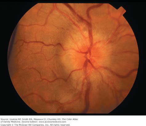 Papilledema | Basicmedical Key