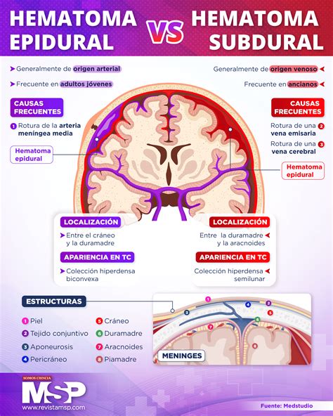 Epidural Hematoma Vs Subdural Hematoma Medizzy - vrogue.co