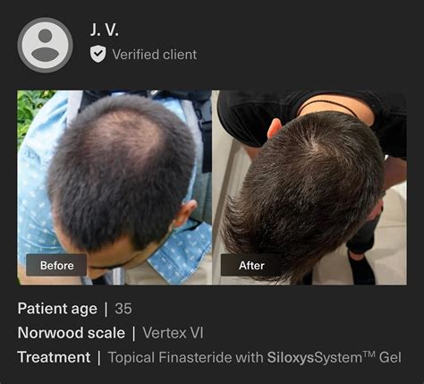 Topical Finasteride | Reduced Side Effects, Amazing Results!