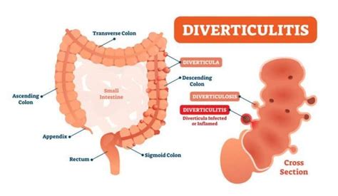 Can Diverticulitis Affect the Bladder? 5 Symptoms You Should Know!