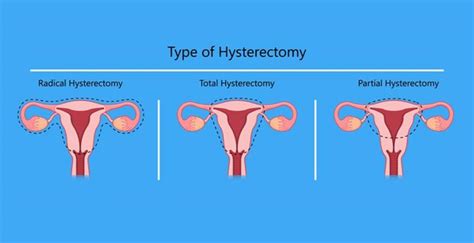 Hysterectomy (Uterus Removal) | Mount Elizabeth Hospitals