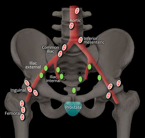 Prostate Cancer Pelvic Lymph Nodes