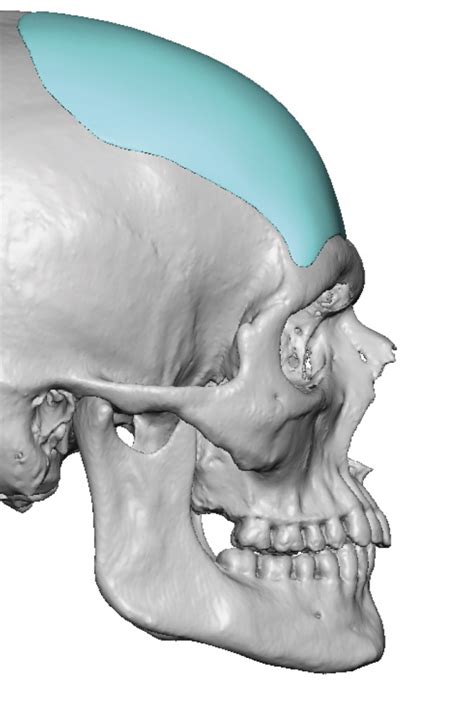 Plastic Surgery Case Study - Custom Forehead Augmentation In Male ...