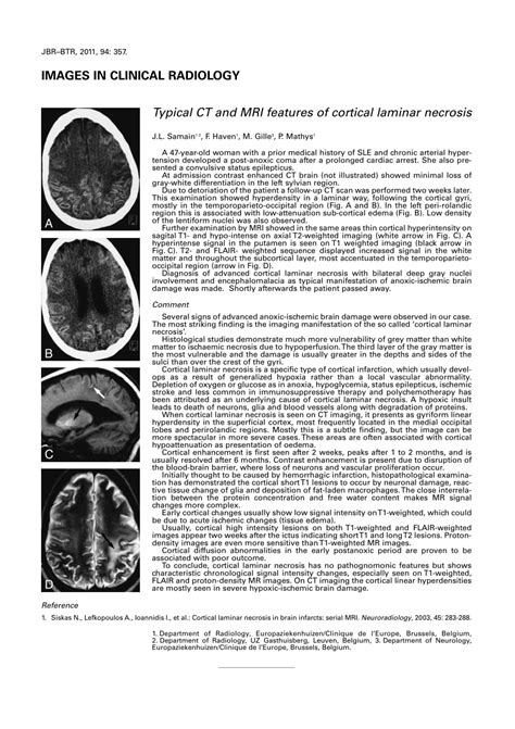 (PDF) Typical CT and MRI features of cortical laminar necrosis