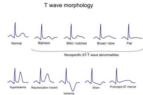 Come leggere un ECG - Peer4Med