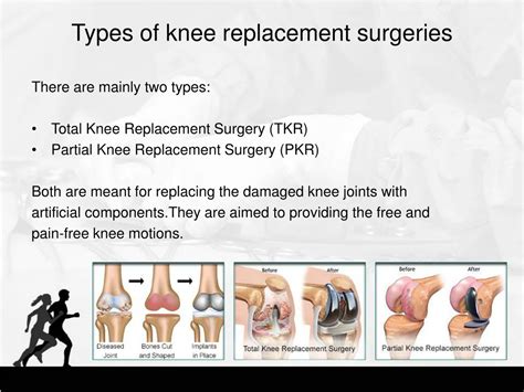 Total Knee Replacement Types