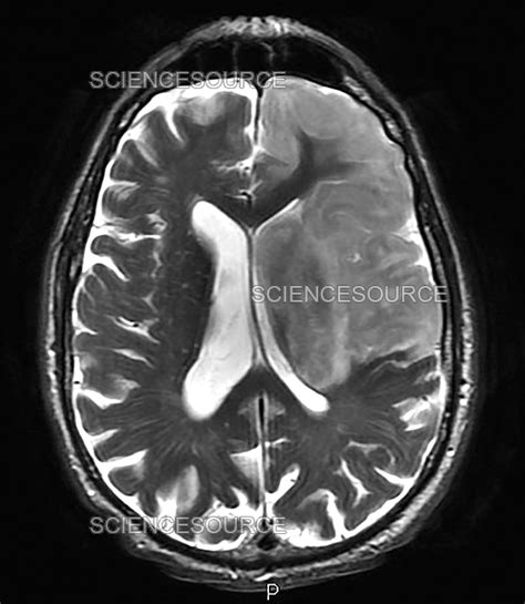 Hemorrhagic Stroke, MRI | Stock Image - Science Source Images