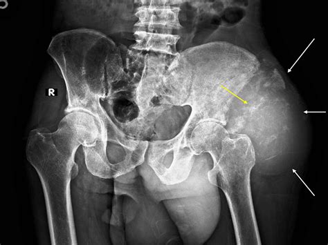 Chondrosarcoma of Iliac Bone Imaging Spectrum With Histopathological Correlation: A Case Report ...