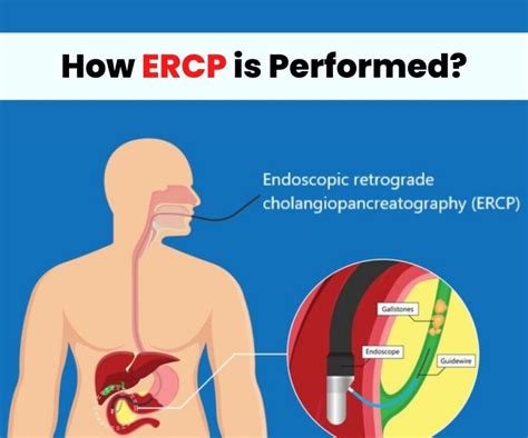 What is ERCP? How ERCP is performed?