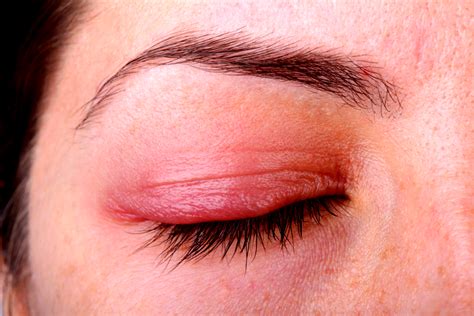 Ocular Rosacea - Causes, Symptoms & Treatment in Miami