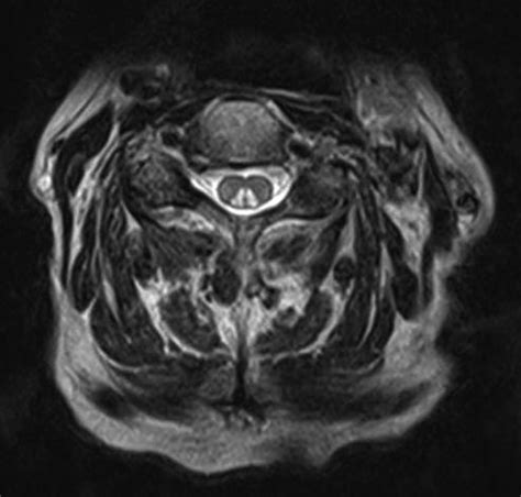 Subacute combined degeneration of the spinal cord due to vitamin B12 ...