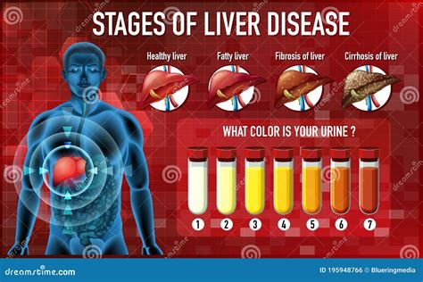 Stages Of Liver Damage. The First Symptoms Of Liver Problems Are Abdominal Pain, Swollen Belly ...