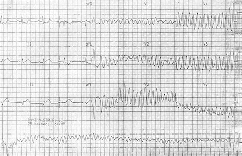 Ventricular Fibrillation (VF) • LITFL • ECG Library Diagnosis