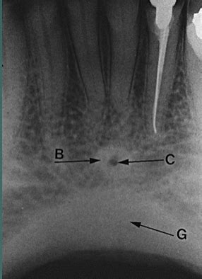 Anatomical Landmarks on Periapical Radiographs (1 of 2) Flashcards ...