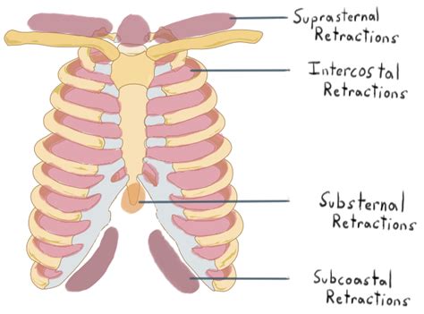 Respiratory distress (article) | Khan Academy