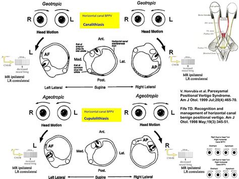 Horizontal canal BPPV Can