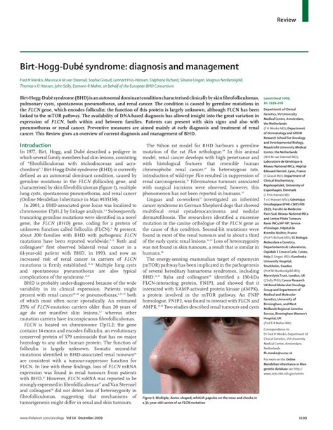 (PDF) Birt-Hogg-Dubé syndrome: diagnosis and management