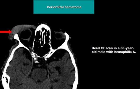 ECR 2013 / C-1575 / Imaging aspects in hemophilia - EPOS™