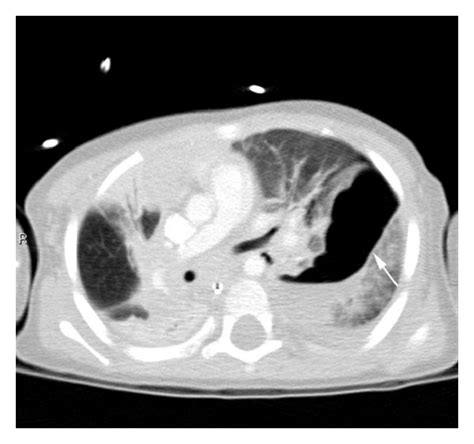 Axial view on CT chest. The pneumatocele measured approximately 6 cm ...