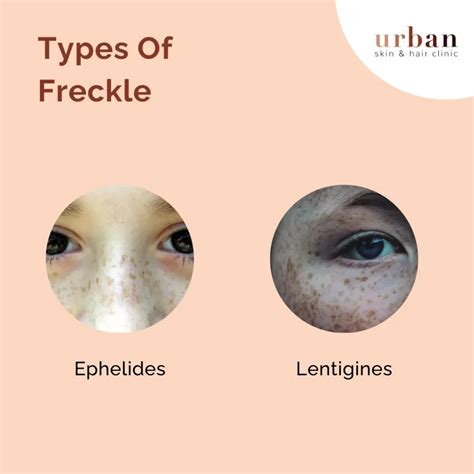 Freckles Types, Causes, Symptoms & Treatment | USHC