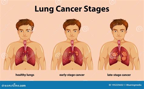 Stages Of Lung Abscess Cartoon Vector | CartoonDealer.com #137679509