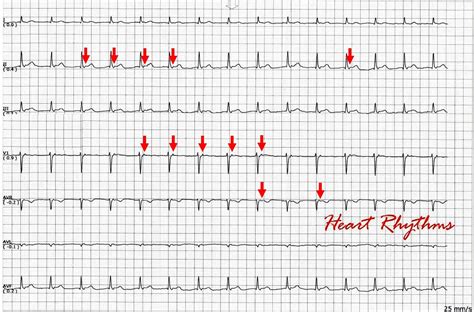 ECG Rhythms: Isorhythmic AV dissociation