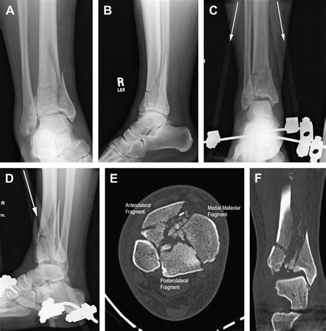 Fractures of the Tibial Plafond - Foot and Ankle Clinics