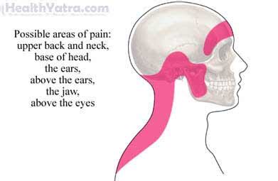 Tension Headache Treatment in India, Causes, Symptoms and Top Hospital ...