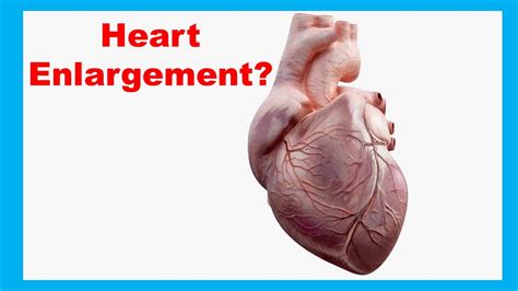 Enlarged Heart (Cardiomegaly): Causes, Treatment, And More, 45% OFF