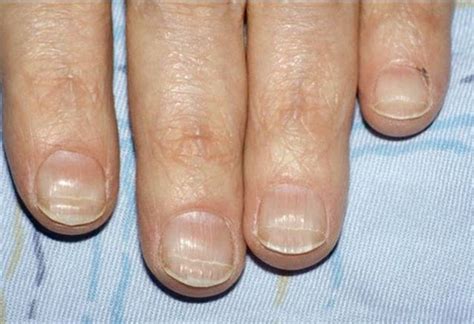 What Are Beau's Lines? in 2020 (With images) | Lines on nails, Nail conditions