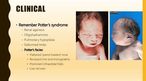 FlashPath - Lung - Pulmonary Hypoplasia