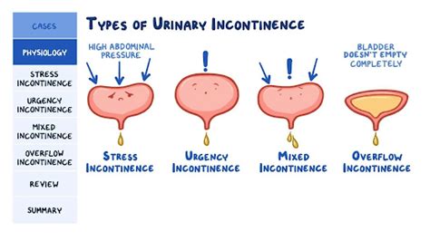 Urine Incontinence Types