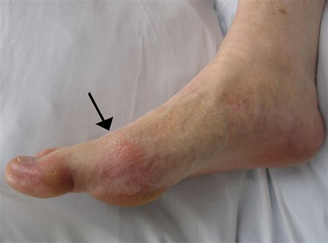 All About Gout Symptoms and Signs