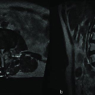 L-spine MRI(2013. 2. 12) a : L3~L4 stenosis. b : L4~L5~S1 PLIF ...