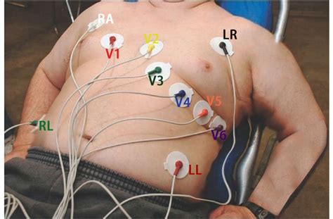 12 lead ECG placement on Fat guy guide | YQF Medical Cable