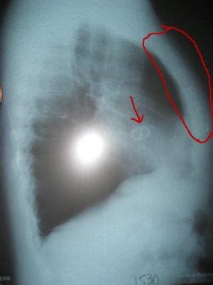 Heart Valve: Artificial Heart Valve X Ray