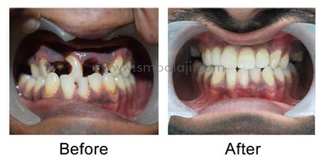 Rotten Teeth Before And After