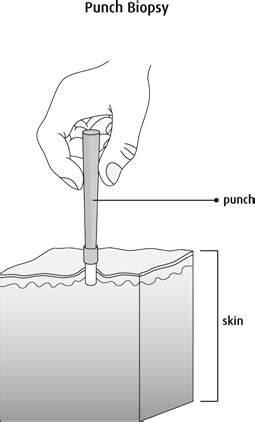 Punch biopsy | Canadian Cancer Society